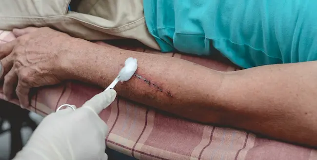 A dog bite injury victim is receiving medical treatment for severe wound, requiring stitches after an attack.